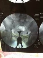 广元可以做试管婴儿，广元有医院可以做羊水穿刺吗？